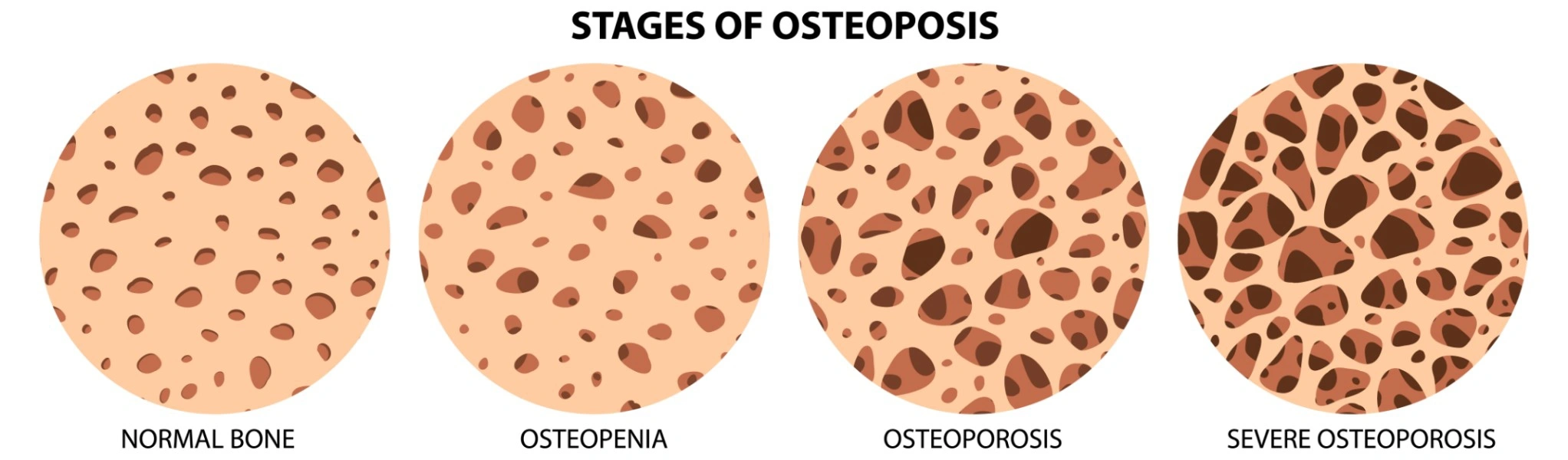Mengapa Lansia Rentan Osteoporosis?