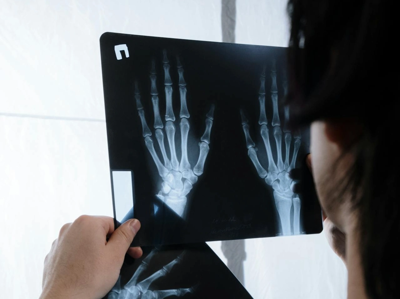 Apa Itu Radang Sendi Jari Tangan?