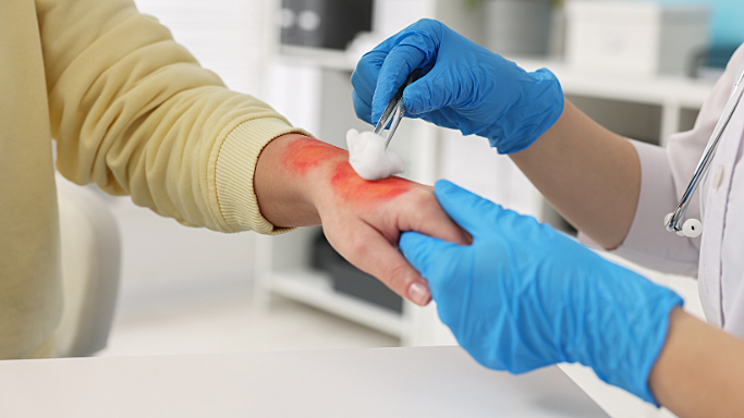 Langkah Perawatan Luka Bakar Ringan agar Tidak Menjadi Infeksi